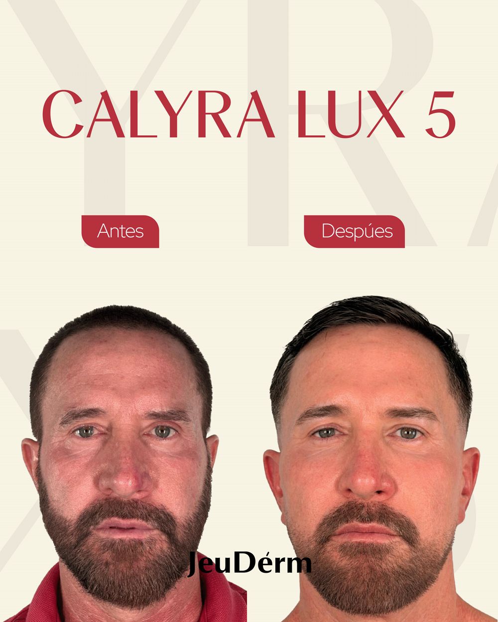 Antes y después Calyra Lux 5