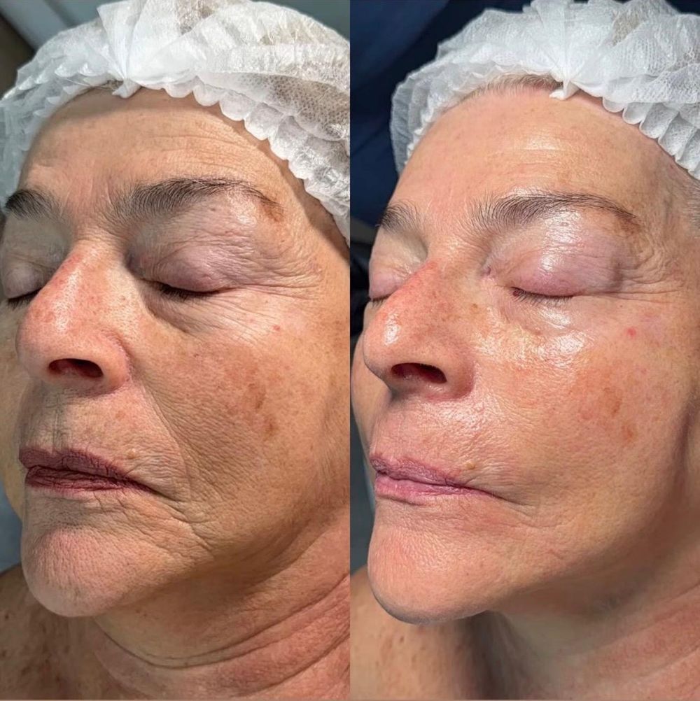 Antes y después rejuvenecimiento facial