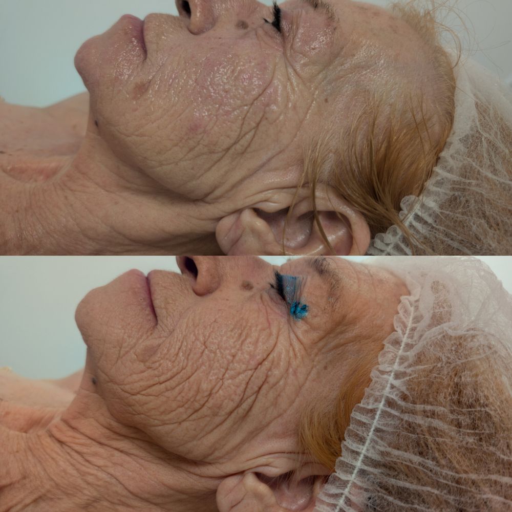 Antes y después lifting coreano