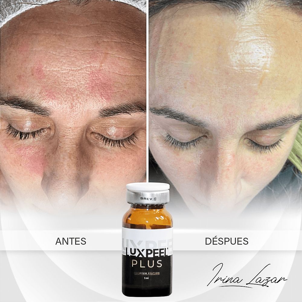 Antes y después LuxPeel Plus