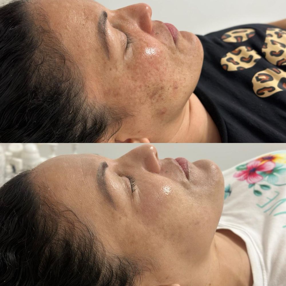 Antes y después LuxPeel