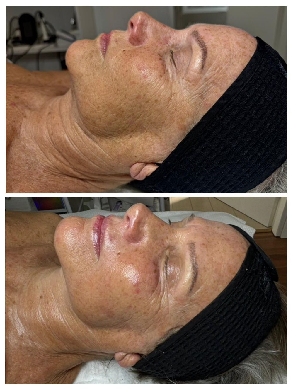 Antes y después despigmentación