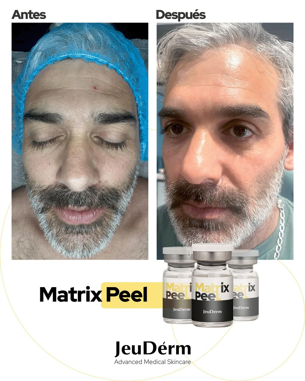 Antes y después Matrix Peel